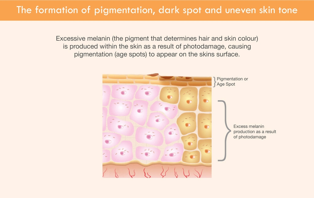 The Formation of Dark Spot & Uneven Skin Tone